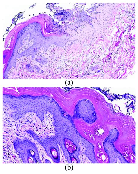 A Hematoxylin And Eosin Photomicrograph × 10 Revealing Abrupt