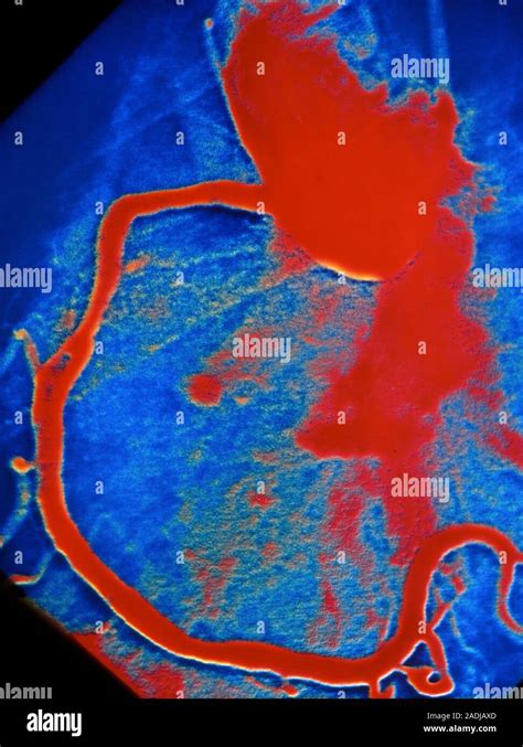 Post Angioplasty Coloured Angiogram Taken After A Percutaneous