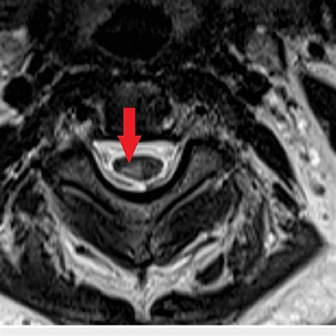 T2 Weighted Axial Image Showing Hyperintense Signal In The Cervical