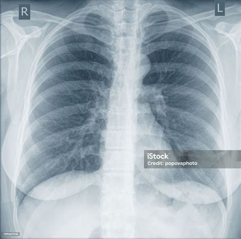 Gambar Sinarx Dada Manusia Untuk Diagnosis Medis Foto Stok Unduh