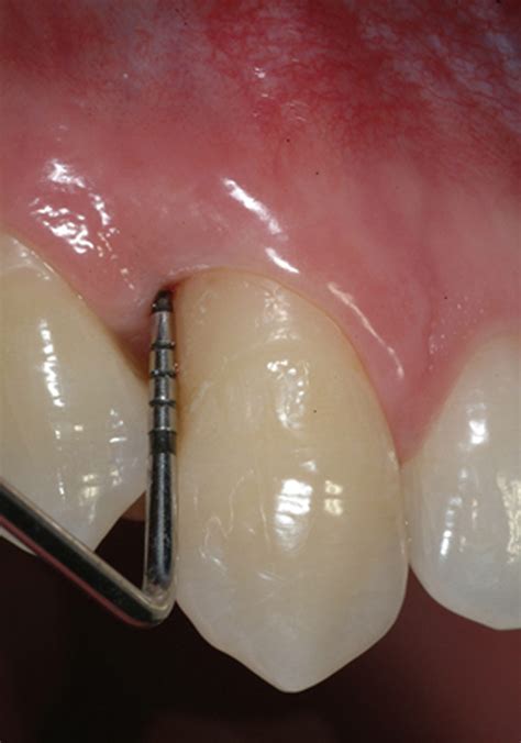 Advanced Regenerative Technologies For Periodontal Tissue Repair Pmc