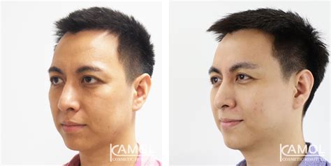 Forehead Lift Brow Lift Kamol Cosmetic Hospital