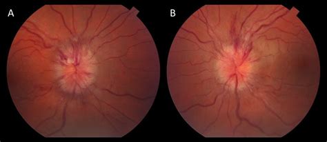 Moran Core Case Report Of Idiopathic Intracranial Hypertension And