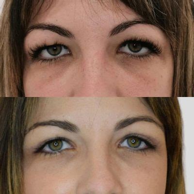 Blefaroplastia Contraindicaciones Y Riesgos Dr Joan San Miguel