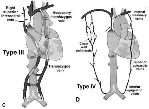 Reconstruction Of The Superior Vena Cava Benefits Of Postoperative Surveillance And Secondary