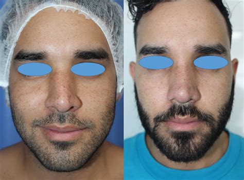 Diferencias Entre Una Rinoplastia Abierta Y Cerrada Cirugia Martinez