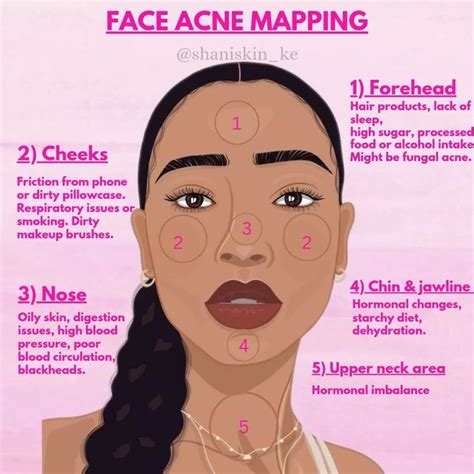 Acne Mapping Face Acne Acne Mapping Forehead Acne