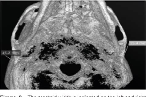 Figure 2 From Sex Determination By Osteometric Assessment Of The