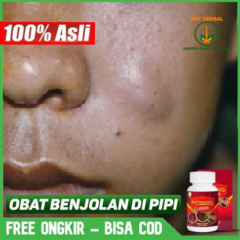 Jual Obat Benjolan Di Pipi Pipi Bengkak Sakit Gigi Gusi Sarmucare