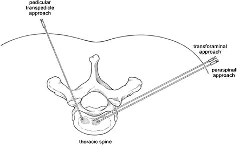 Table 2 From Percutaneous Needle Biopsy Of The Spine Semantic Scholar