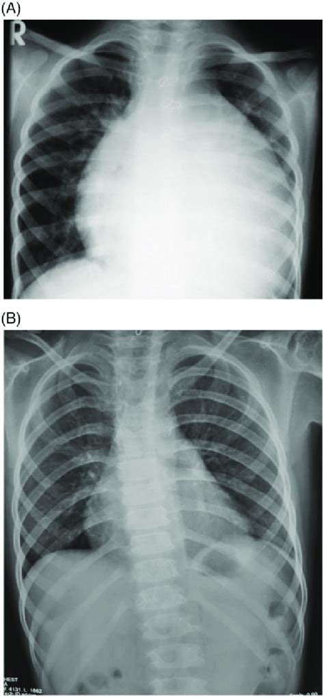 A Chest X Ray PA View Showing Massive Cardiomegaly With Normal Lung