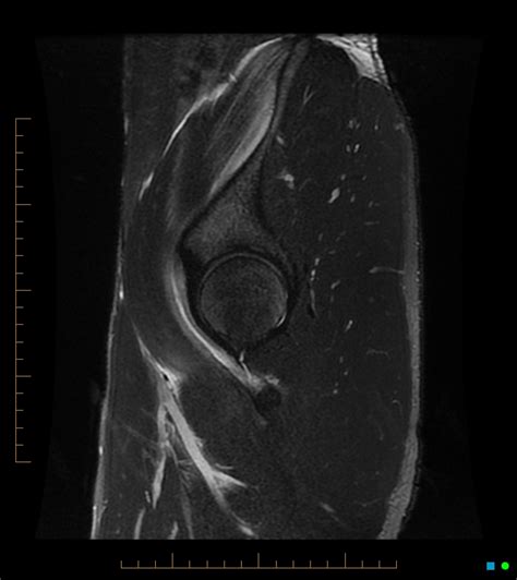 Radiology Cases Iliopsoas Muscle Tear