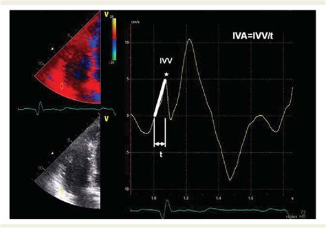 [pdf] The Echocardiographic Assessment Of The Right Ventricle What To