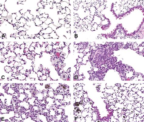 Asbestosis Histology