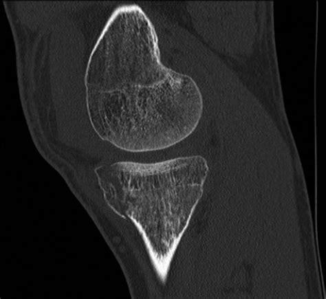 Ultrasound For Knee Effusion Lipohaemarthrosis And Tibial Plateau Fracture Rippey 2014