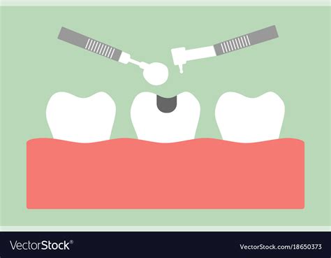 Tooth Amalgam Filling With Dental Tools Royalty Free Vector