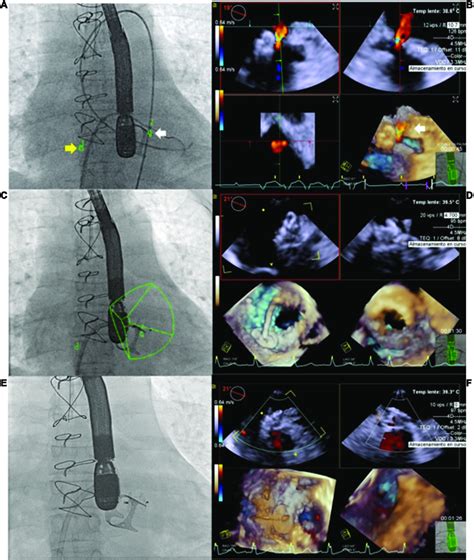 Use Of Echocardiography Fluroroscopy Fusion Eff To Facilitate