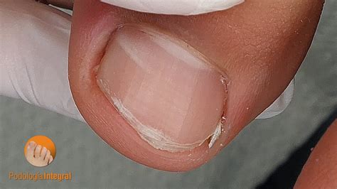 Please do not trim your nails with your hands Podología Integral