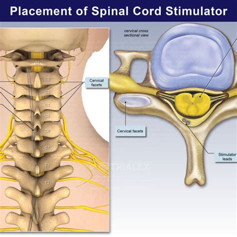 Placement Of Spinal Cord Stimulator Trialexhibits Inc