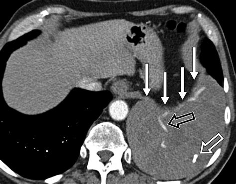 Solid Pleural Lesions Ajr