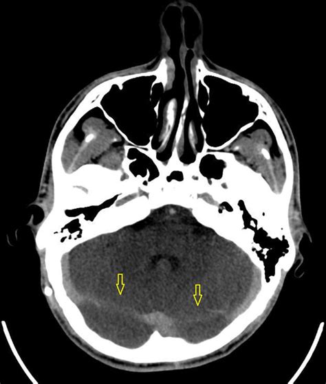 Bilateral Transverse Sinus Stenosis Causing Intracranial Hypertension