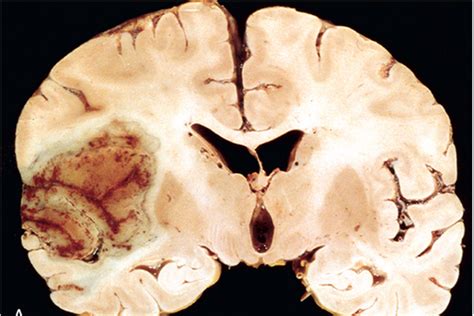 Cerebrovascular Diseases Mrak Flashcards Quizlet