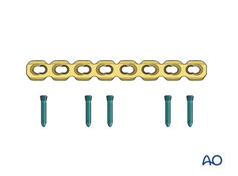 Primary fusion of naviculocuneiform joint for Complete articular ...