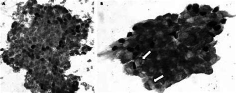 P Immunocytochemistry Highlighting Myoepithelial Cells Overlying