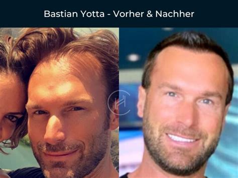 Promis Mit Haartransplantation Vorher Nachher Vorher Nachher