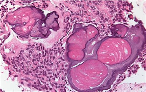 Ghost Cells Calcifying Odontogenic Cyst