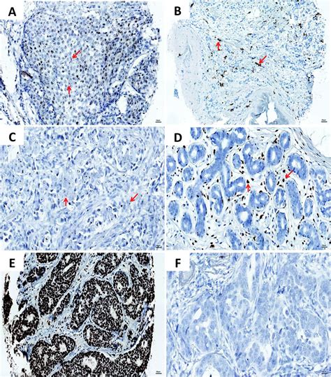 Long Non Coding Rna Chromogenic In Situ Hybridisation Signal Pattern