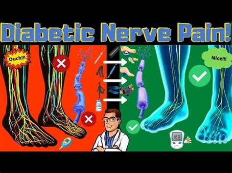 Diabetic Peripheral Neuropathy Treatment [REVERSE Diabetic Nerve Pain]