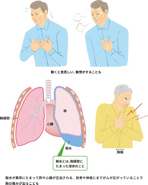 肺がんの症状について、胸や背中の痛みなど主な症状一覧｜おしえて 肺がんのコト【中外製薬】