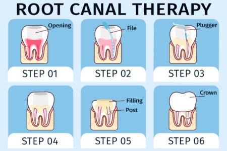 Understanding Pulpotomy Pulpectomy Root Canal Therapy