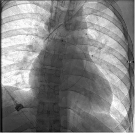 Management Of Acute Pulmonary Embolism In A Patient With Sickle Cell