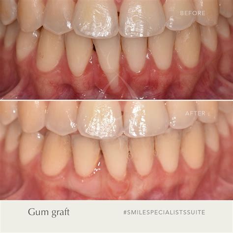 Gum Graft Smile Specialists Suite