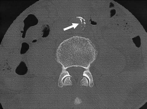 Chronic Contained Rupture Of Abdominal Aortic Aneurysm That Developed