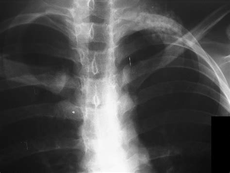 Figure 1 From Osteoid Osteoma Of The Rib Presenting As Thoracic Outlet Syndrome Semantic Scholar