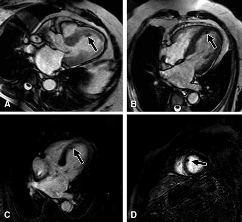 Takotsubo Cardiomyopathy On Pocus 78 Year Old Woman Grepmed Hot Sex