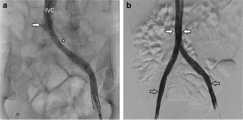 Iliac vein compression syndrome in a 16-year-old boy. a Anteroposterior ...