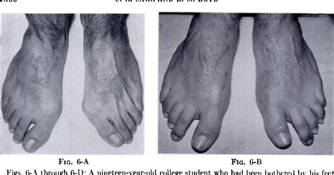 Figure 2 from Correctional osteotomy for metatarsus primus varus and hallux valgus. | Semantic ...