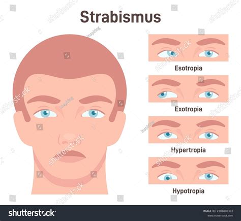 187 Human Eye Strabismus Surgery Images, Stock Photos & Vectors ...