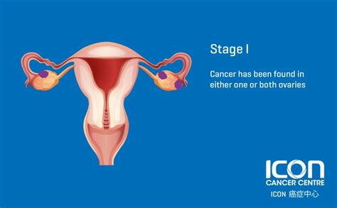 Ovarian Cancer — Icon Cancer Centre Hong Kong