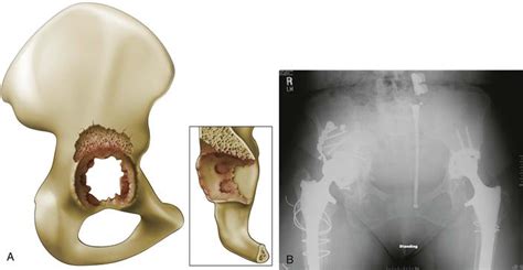 Acetabular Reconstruction Classification Of Bone Defects And Treatment Options