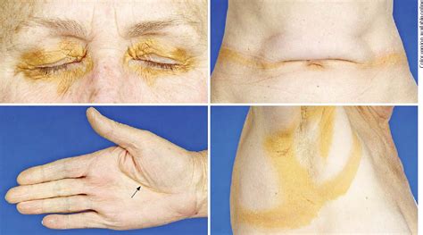 Figure 1 From Diffuse Plane Normolipemic Xanthomatosis Associated With