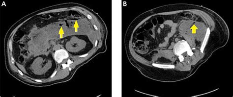 Necrotizing Pancreatitis Diagnose Treat Consult Cleveland Clinic Journal Of Medicine