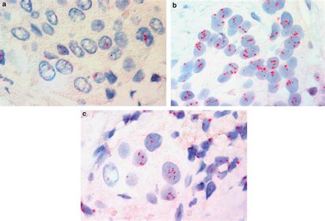 Dual Color In Situ Hybridization Analysis Was Used To Evaluate Her