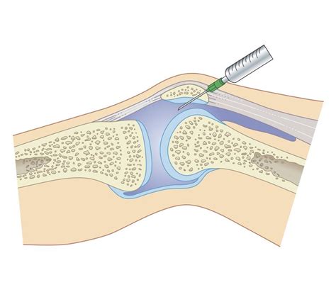 Injection D Acide Hyaluronique Dans Le Genou Pour Soulager L Arthrose