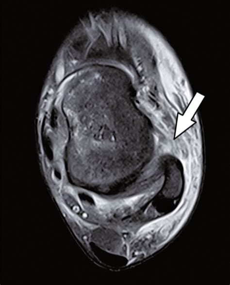 Scielo Brasil Acute Ankle Injuries Association Between Sprain