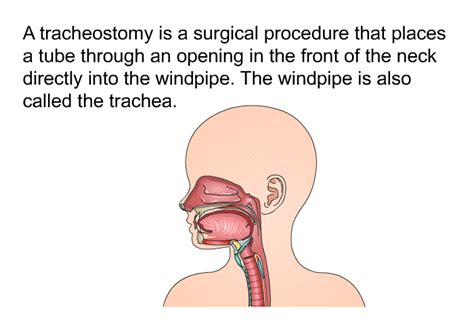 PatEdu Trach Care Pediatrics